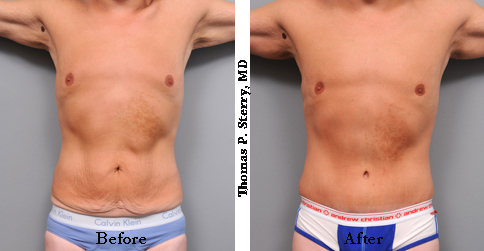 male tummy tuck gynecomastia