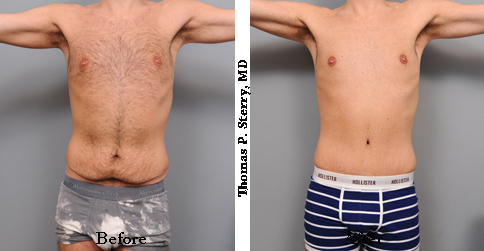 male tummy tuck photo before and after