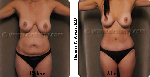 tummy tuck after twins