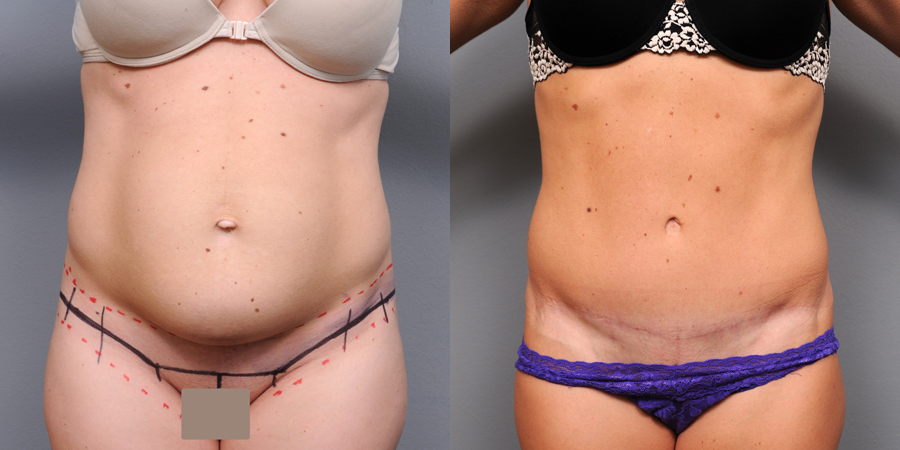 Before a tummy tuck, woman’s torso is marked in ink along incision lines. After photo shows flat belly and very faint scar.