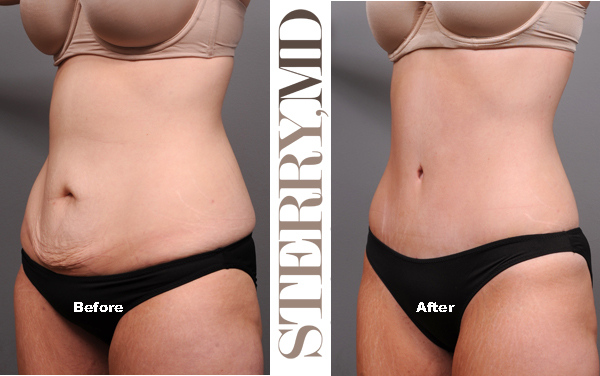 learn more about tummy tuck in NYC