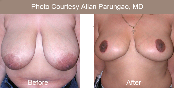 Visor flap breast reduction scars are shown.
