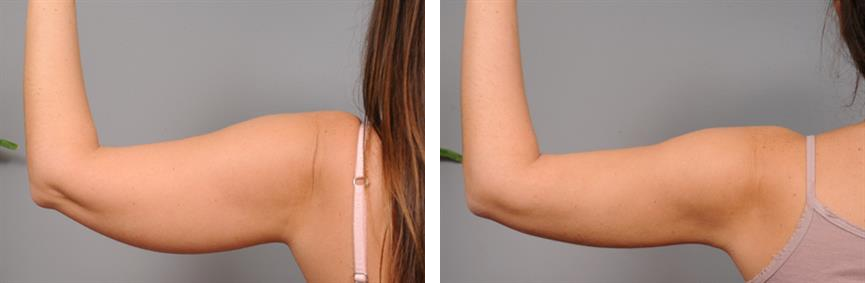 Before and after arm liposuction