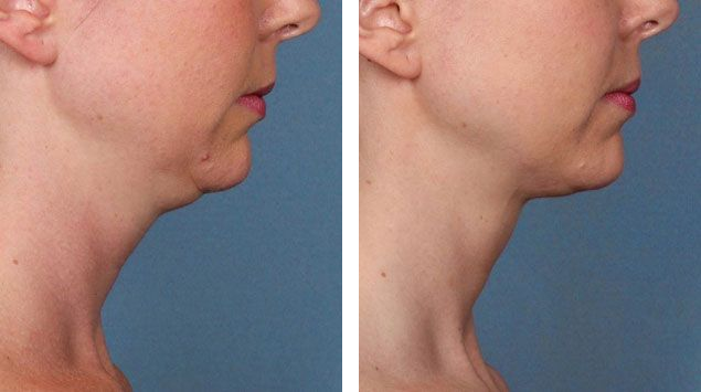 Before and after Kybella