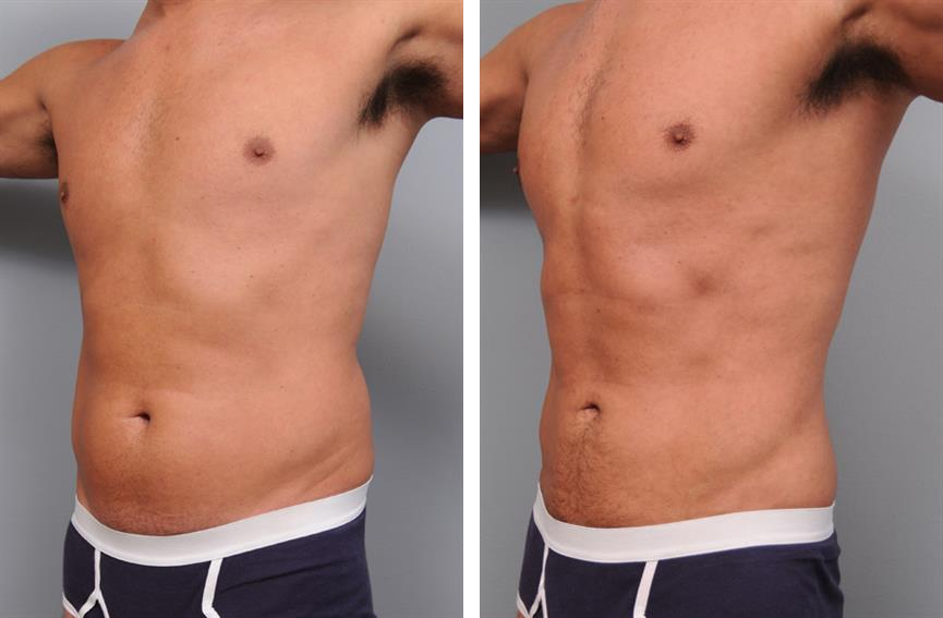 Before and after smartlipo for men