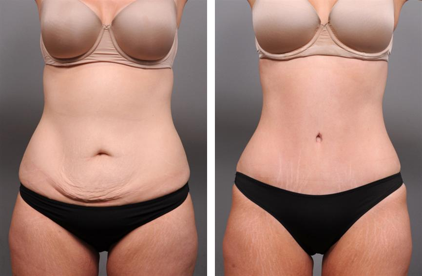 Before and after of tummy tuck and liposuction