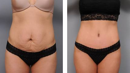 Before and after tummy tuck