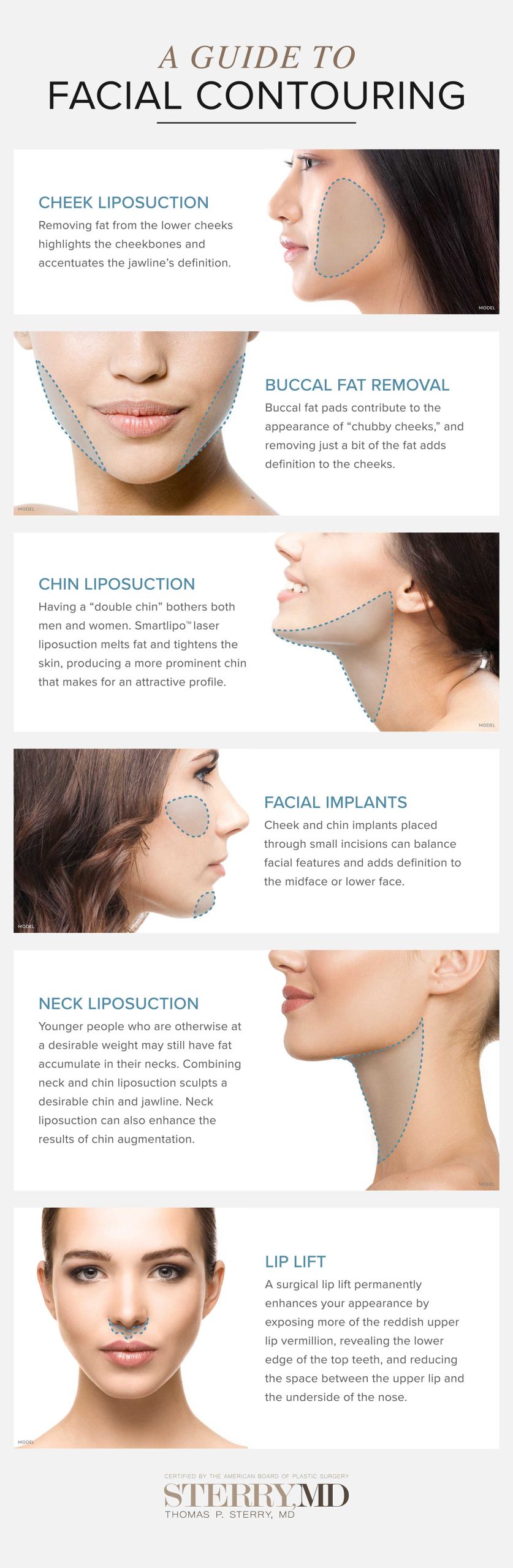 A guide to facial contouring. A diagram of the different types of facial contouring procedures there are and what they do. (models)
