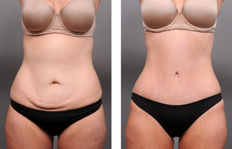 Before and after images of a female patient's tummy tuck.