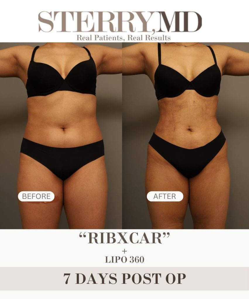 RibXcar before and 7 days after in New York City by Dr. Thomas Sterry.