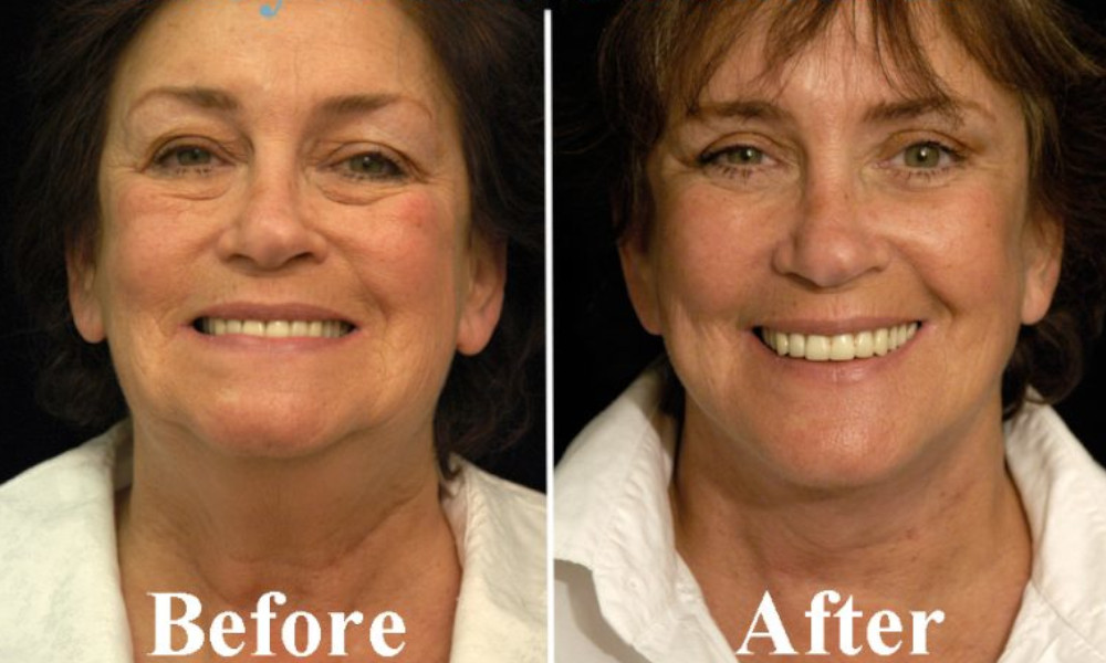 Best Facial Plastic Surgery & Facelift In New York Featured Image - Dr Sterry Before and after Photos