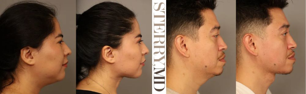 Facelift Before and After Photos - Different Types Of Facelift And Neck Lift - Dr Sterry