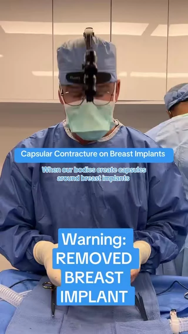 Capsular contracture: When scar tissue tightens around a breast implant, causing discomfort and altering shape. Talk to your doctor or surgeon about the best options for treatment! 
This patient thought she had saline implants, which is not what she had. Make sure you talk with your doctors and know what implants you are getting!! 🍒
#plasticsurgery #breastaugmentation #capsule #capsularcontracture #surgerytiktok