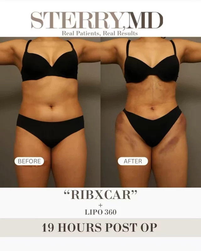 RIBXCAR BEFORE & AFTER🩻: You asked, and we delivered! Here is a patient just 19 hours post-op from the RibXCar procedure, which we’re now calling “INVISARIB”. While there’s a lot of swelling and bruising, the patient is already seeing amazing results! She will continue wearing a garment that she’ll tighten each week, ensuring ongoing progress. Truly, it’s like Invisalign for your ribs! We will continue to post more details and information about the procedure! Feel free to ask any questions about this amazing, life changing procedure!🥳
#ribxcar #invisarib #plasticsurgery #nyc #surgerytiktok #drsterry #results #recovery