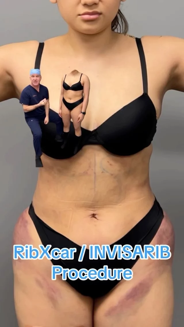 RibXcar: Redefining your body structure and transforming your frame, no matter your weight – Unlock a new you!🍑🍒

#drsterry #plasticsurgeonnyc #rib #ribxcar #invisarib #plasticsurgery #