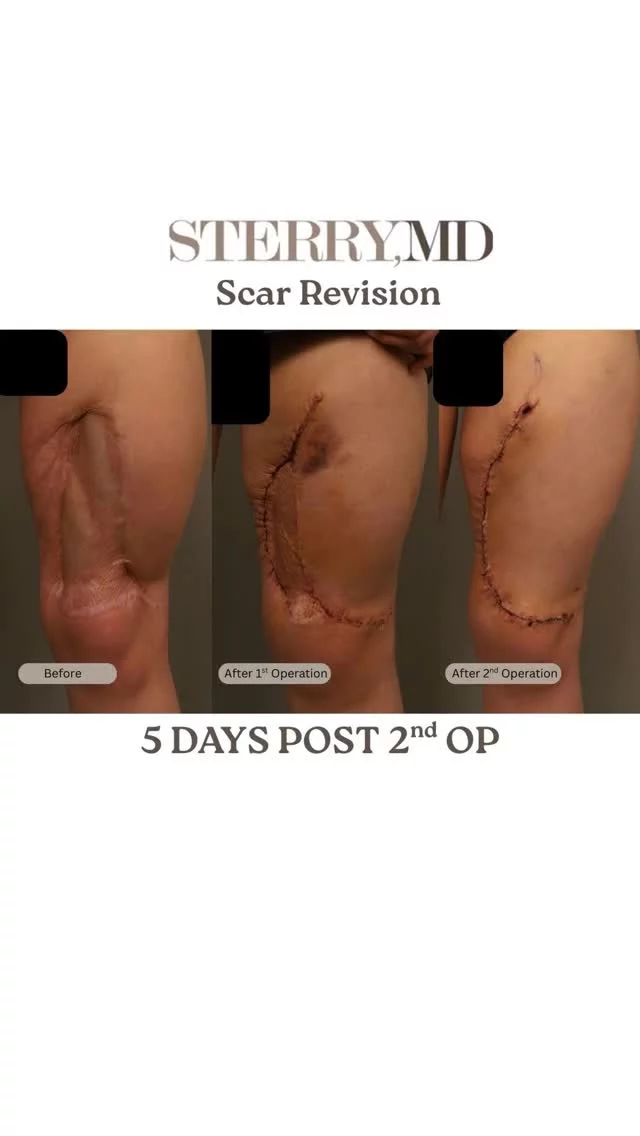 This incredible patient traveled a long way for her scar revision journey! It’s just 5 DAYS post-op from her second procedure, following a motor vehicle accident. I’m truly honored she trusted me with her care after consulting with several doctors. So proud of her healing progress already—excited to see the final results in the coming months!!💉

#ScarRevision #HealingJourney #PostOpRecovery #PatientCare #Grateful #PlasticSurgery #RecoveryProgress #MotorVehicleAccident #BeforeAndAfter #ScarTreatment #drsterry #plasticsurgeon #nyc #boardcertifiedplasticsurgeon