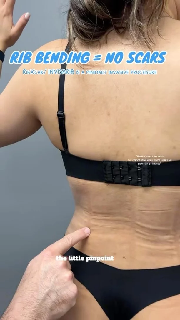 Rib bending is a total game-changer!✨ Minimally invasive, no visible scars, and beautiful, natural-looking results with a smooth recovery. Perfect for those looking for subtle yet impactful enhancement!

#NoScars #RibBending #MinimallyInvasive #NaturalResults #BodyGoals #ConfidenceBoost #PlasticSurgeryJourney
