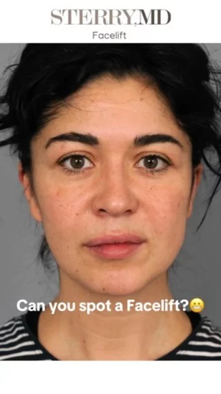 You can spot that facelift? THAT DEPENDS ON WHO DOES IT‼️ With my expertise she is glowing, rested, and serving ‘I woke up like this’ energy!! Sometimes a lift brings a lot of light☺️
#facelift #beforeandafter #drsterry #plasticsurgerynyc #faceliftexpert #nyc
