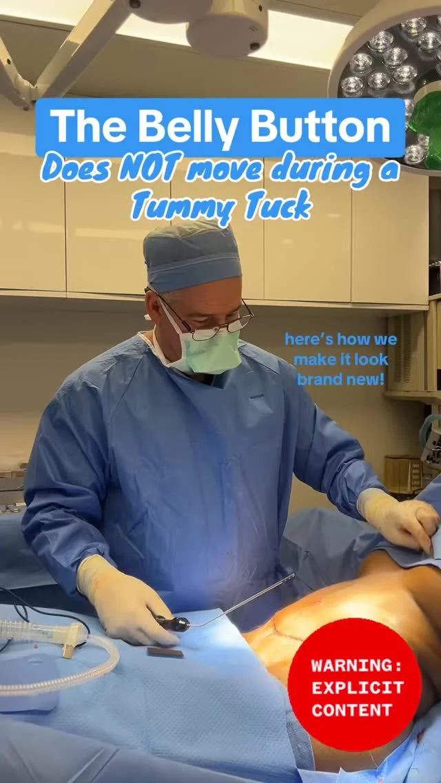 The belly button is the ultimate giveaway of a good (or bad) tummy tuck 😷🧐 Let’s talk details!! 
#drsterry #lipo #tummytuck #recovery #lipo360 #bellybutton