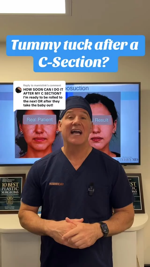 Just had a C-section? Let your body recover fully before thinking about a tummy tuck—timing is everything when it comes to results! Healing is always the most important factor in any procedure!❤️‍🩹 #healingjourney #csection #tummytuck #boardcertifiedplasticsurgeon #results #drsterry #nyc #plasticsurgerynyc