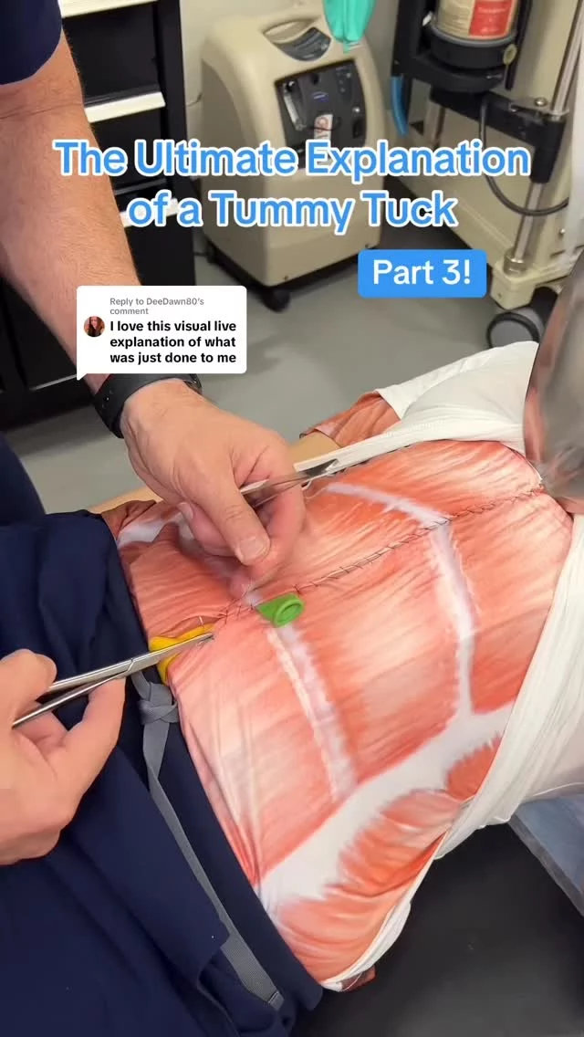 Here’s Part 3! Of the tummy tuck breakdown using shirts 👕
I’m loving all the questions you’ve been asking—keep them coming! I’ll be answering each one thoroughly as soon as I can. 💬🩺