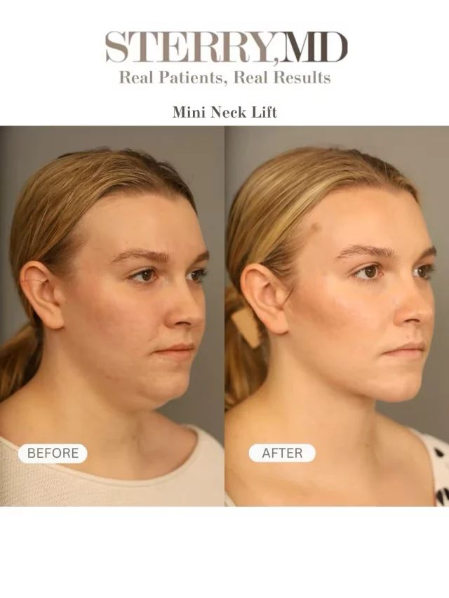The POWER of a MINI Neck lift ✨
A mini neck lift can do more than you think! Subtle refinement, smoother contours, and a more defined neckline—without moving skin! Have questions about a mini neck lift or a full neck lift? I’m happy to help☺️
#drsterry #plasticsurgery #mininecklift #surgerytiktok