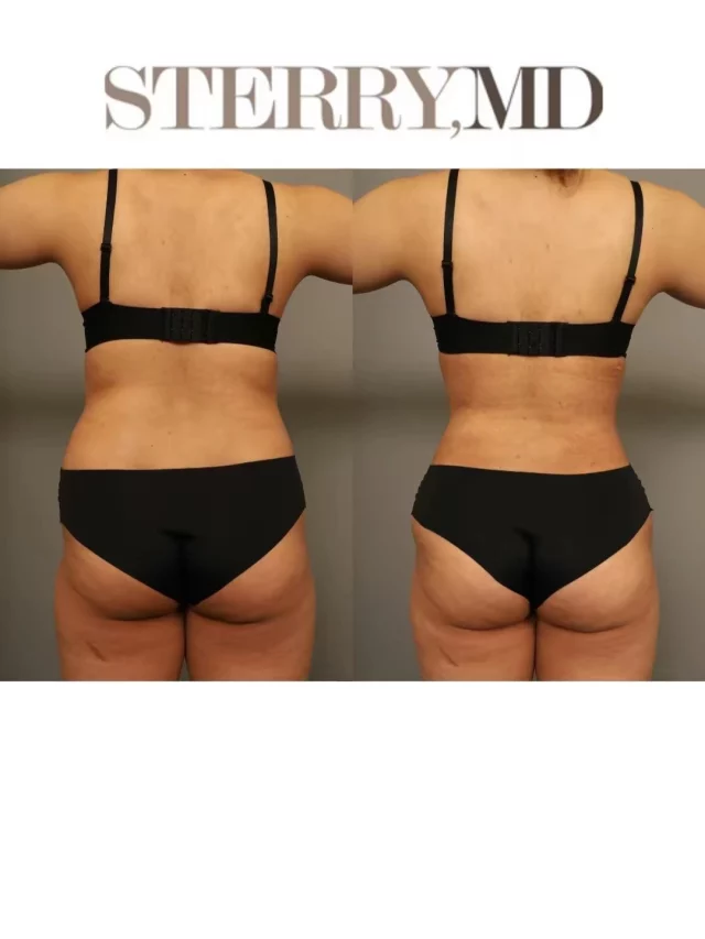 Rib contouring changes the silhouette in ways you can’t unsee!☺️🩻
 
Before ➝ 3 weeks ➝ 3 months

This patient also had lipo360 for added enhancments! 

#ribcontouring #ribxcar #lipo360 #drsterry #beforeandafter