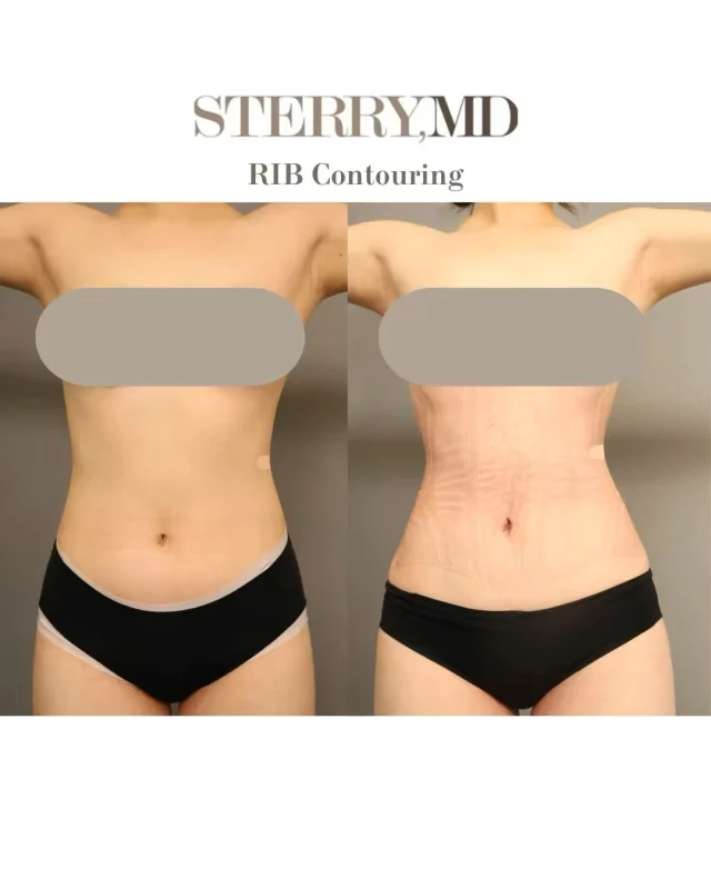 3.6 inches gone — and the body contour is truly life-changing!✨

In only 3 months, she’s down 3.6 inches and experiencing a genuinely life-changing body contour. Real results happen when the right treatment meets real commitment. We love watching our patients step into their confidence.
#ribcontouring #ribxcar #realpatient #realresults