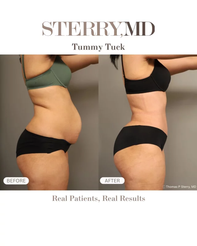 A tummy tuck doesn’t just change your front view 👀
It transforms your side profile, waist definition, posture, and overall silhouette! 
#tummytuck #realpatients #realresults #nycplasticsurgeon #drsterry