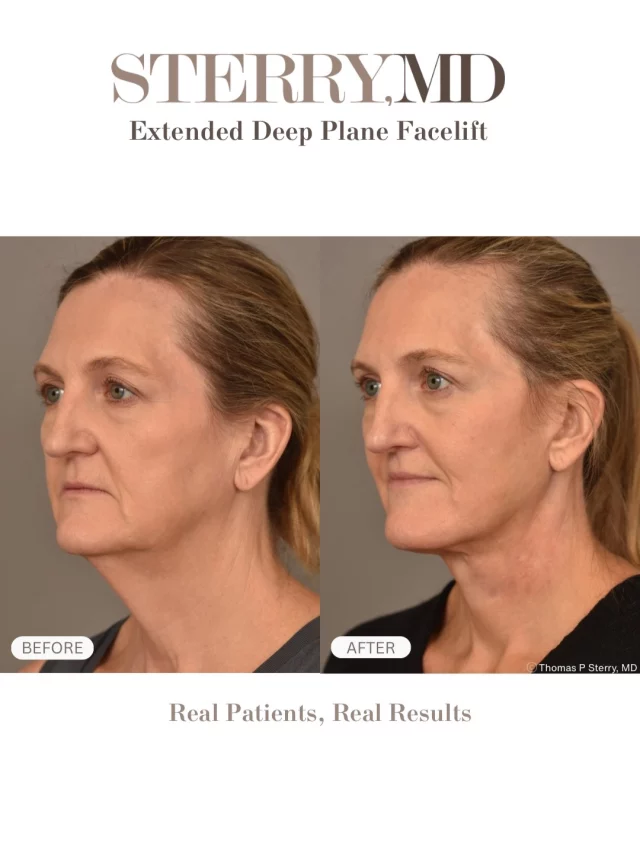 A facelift IS NOT about changing who you are — it IS about turning back time in a way that still looks like you!
Results shown are real, individualized, and performed with precision and intention! ✨
#realpatients #realresults #facelift #nycplasticsurgeon #deepplaneextendedfacelift