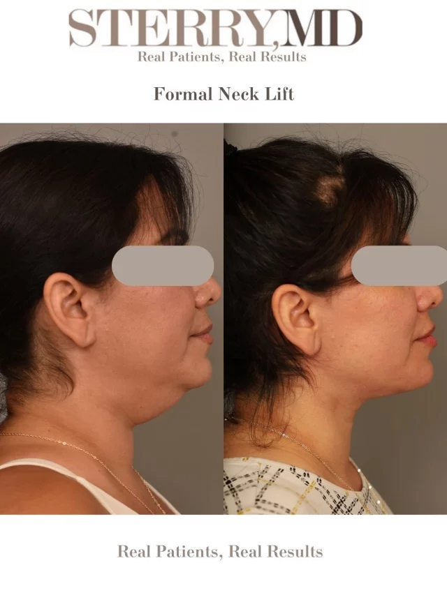 A neck lift restores a smooth, defined jawline by tightening muscles and removing excess skin. Natural & Refreshed! Feel free to call us at +1 (646) 624-0923 to answer any of your questions or book a consultation!! 😊
