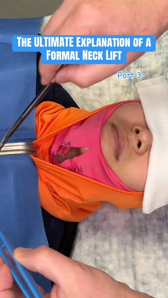 Here is Part 3! The secret to a sharp neckline?
Going under the platysma muscle and reducing the submandibular glands to sculpt the neck from the inside out! 
#drsterry #nycplasticsurgeon #necklift #formalnecklift #necklipo