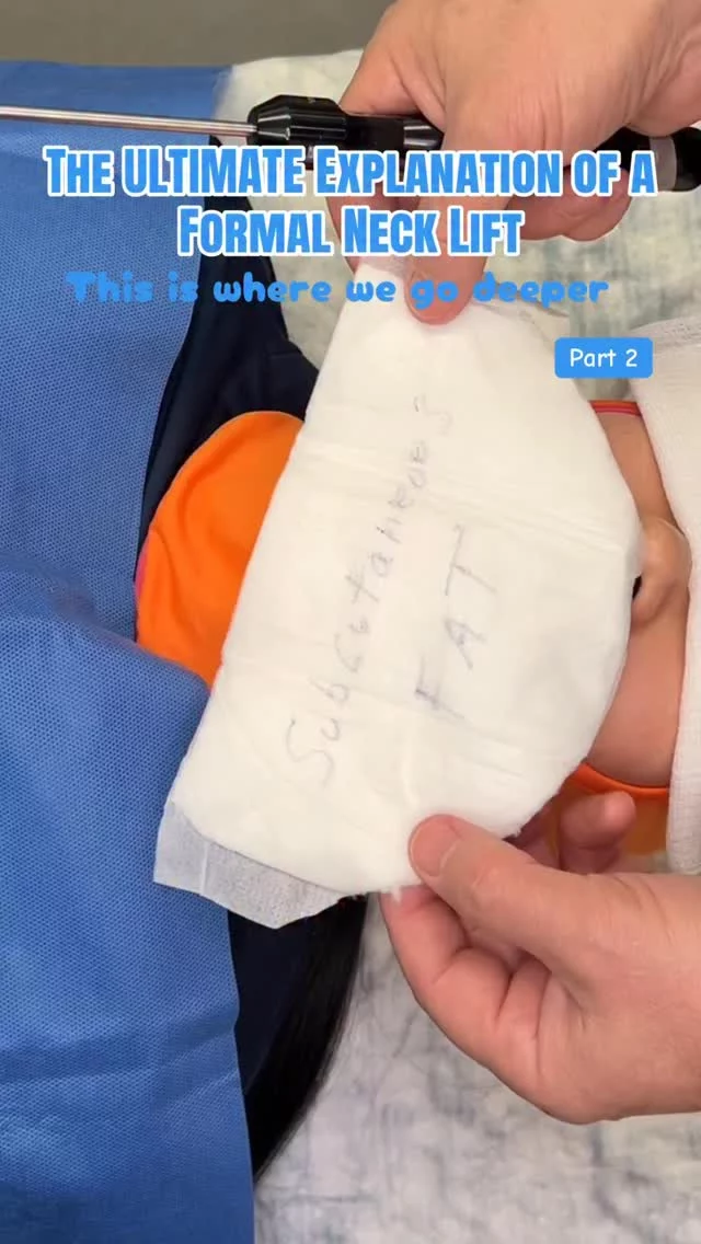 Part 2! This is where we go deeper.

In a formal neck lift, we enter the deep neck space to remove fat stored beneath the platysma muscle. This is not surface-level contouring — this is structural refinement. Addressing this deeper layer is what creates a sharper angle and a more defined, lasting result. 

#necklift #drsterry #nycplasticsurgeon #jawline #deepnecklift