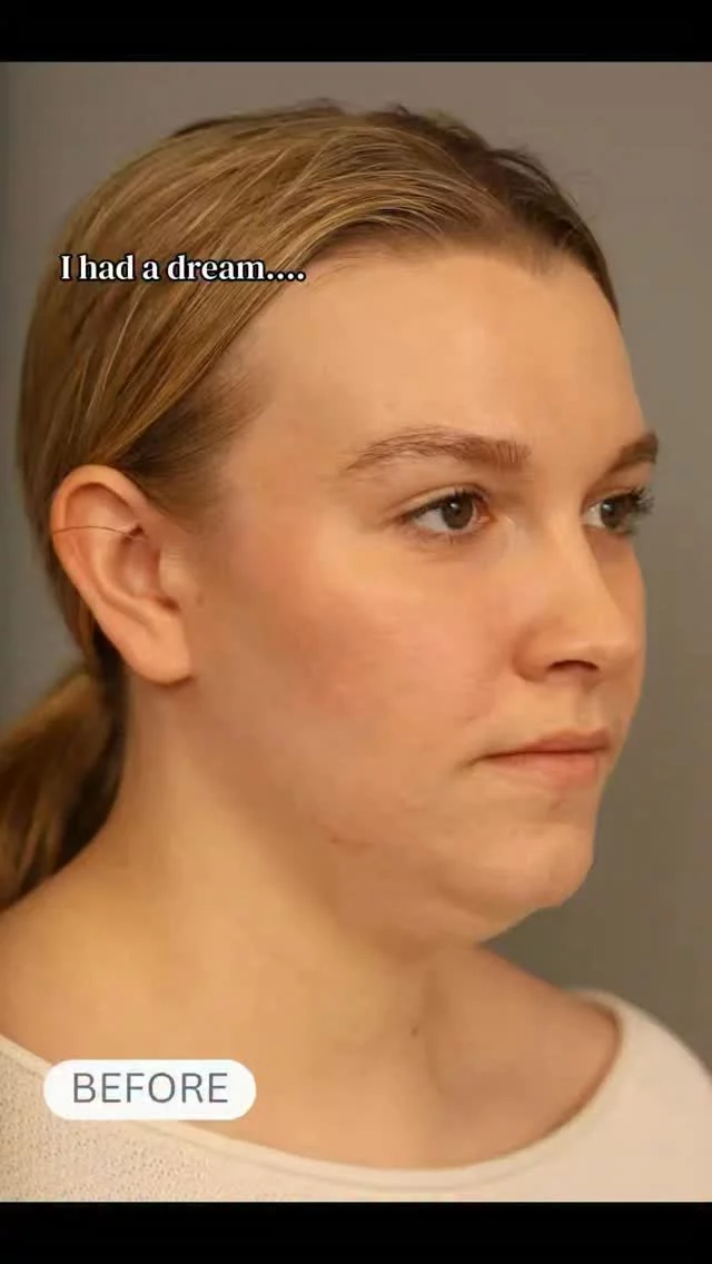 A small lift can make a big difference in creating a smoother, more defined neck contour.

Feel free to call us at +1 (646) 624-0923 to answer any of your questions or book a consultation! 😊 

#drsterry #nycplasticsurgeon #mininecklift #necklift #beforeandafter