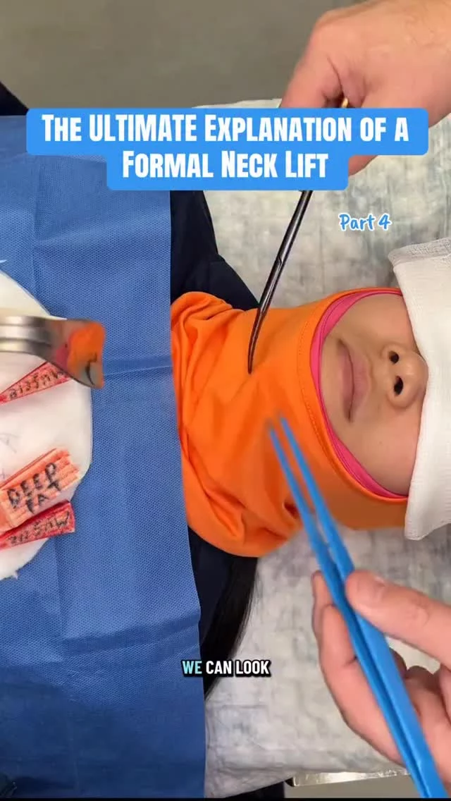 This is the 4th and final part of our formal neck lift series!👔Here we complete the final refinements to create a smoother, more defined neck contour and natural-looking result.

Feel free to call us at +1 (646) 624-0923 to answer any of your questions or to book a consultation! 😊

#nycplasticsurgeon #drsterry #necklift #formalnecklift #necklipo