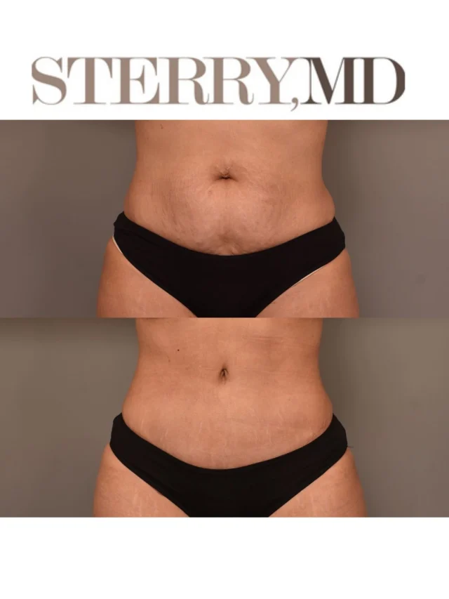 Loose skin, separated muscles, and stubborn fat — a tummy tuck addresses what workouts can’t. The results speak for themselves. 🤯

Feel free to call us at +1 (646) 624-0923 to answer any of your questions or book a consultation! 😊