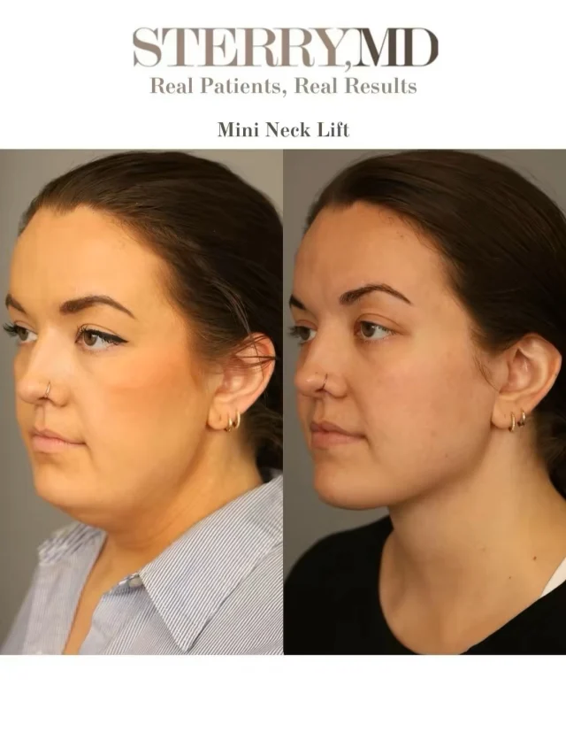 Look at this Mini Neck Lift difference—sharper jawline, tighter neck, and a natural, refreshed look. 👀 
#necklift #nycplasticsurgeon #drsterry #beforeandafters #jawline