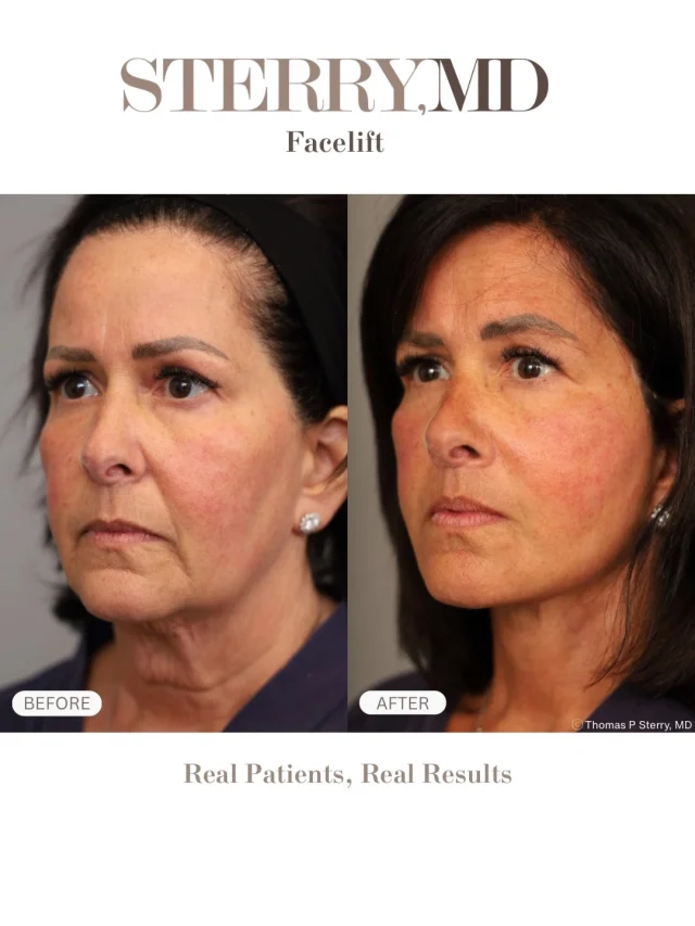A facelift isn’t about pulling skin tight—it’s about repositioning deeper tissues and restoring natural structure. The goal? A refreshed, lifted look that still feels like you!😊 

Feel free to call us at +1 (646) 624-0923 to answer any of your questions or book a consultation!!😊

#nycplasticsurgeon #drsterry #facelift #beforeandafter