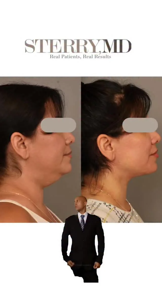 Can anyone guess what procedure this was? 

#drsterry #necklift #mininecklift #necklipo #plasticsurgery
