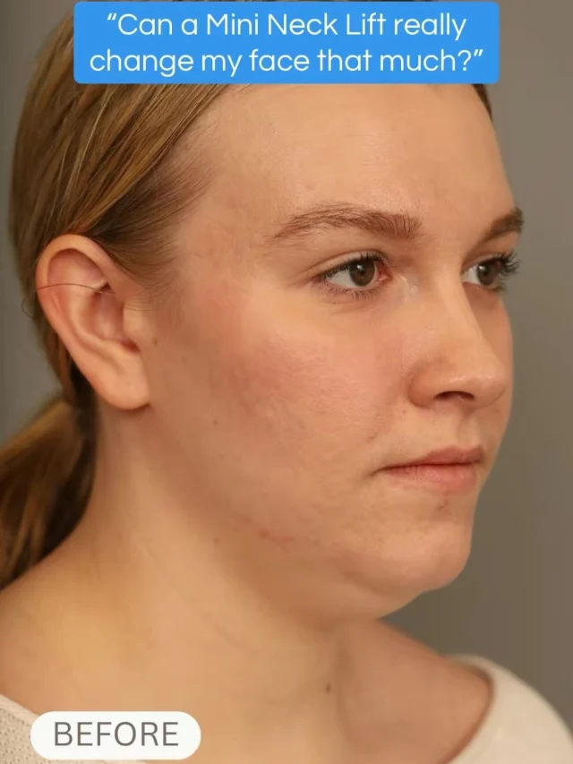 Snatched, subtle, and still you.

A mini neck lift is all about refining the jawline and tightening what time has softened without changing your natural look. Smaller procedure, powerful results!

Call us at +1 (646) 624-0923 to book your consultation 😊

#mininecklift #nycplasticsurgeon #drsterry #beforeandafters
