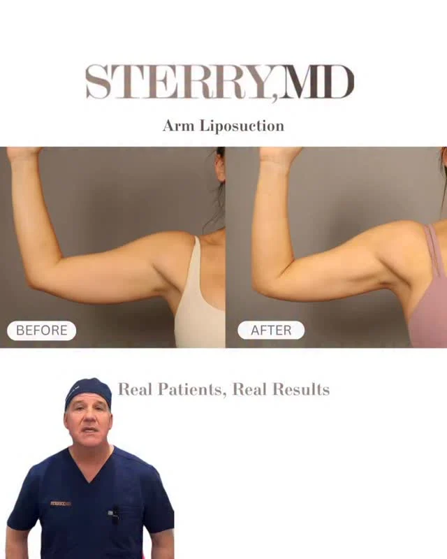 Sculpted, not oversized 💪✨
Arm lipo is all about refining shape and enhancing natural definition—not changing who you are.

📞 Call us at +1 (646) 624-0923 to book your consultation or get your questions answered!
#armlipo #liposuction #nycplasticsurgeon #drsterry