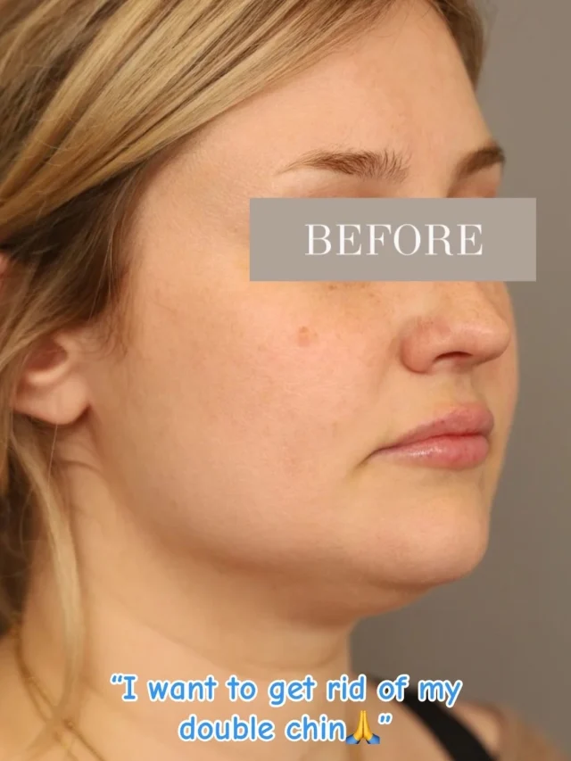 Say goodbye to the double chin and hello to definition 👀

Feel free to call us at +1 (646) 624-0923 to answer any of your questions or book a consultation!!😊
#nycplasticsurgeon #drsterry #liposuction #jawline #beforeandafter