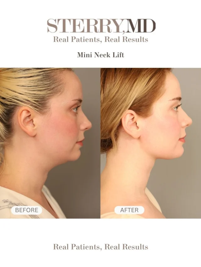 Here is the lovely @queen_astraea with a Mini neck lift and major confidence upgrade ✨

This subtle yet powerful procedure tightens and refines the jawline, helping you look refreshed. Natural results, smoother contours, and a more defined profile. Sometimes it’s the smallest changes that make the biggest difference! 

📞 Call us at (646) 624-0923 to book your consultation or ask any questions!
#nycplasticsurgeon #mininecklift #necklift #drsterry #beforeandafters