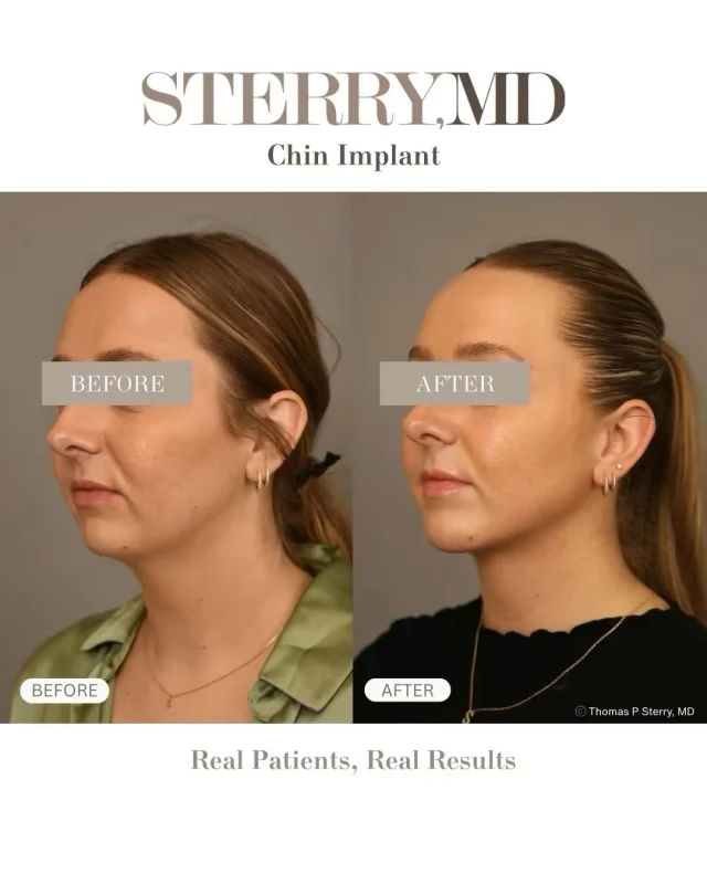 The chin changes everything and most people don’t even realize it!

A chin implant isn’t about making your face bigger, it’s about bringing balance where it was missing. Stronger profile, sharper jawline, and harmony from every angle. Sometimes the smallest change makes the biggest difference.

#drsterry  #plasticsurgery  #ChinImplant #ProfileBalance
