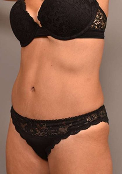 Tummy Tuck Before & After Patient #287