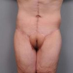 Lower Body Lift Before & After Patient #985