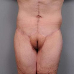 Lower Body Lift Before & After Patient #985