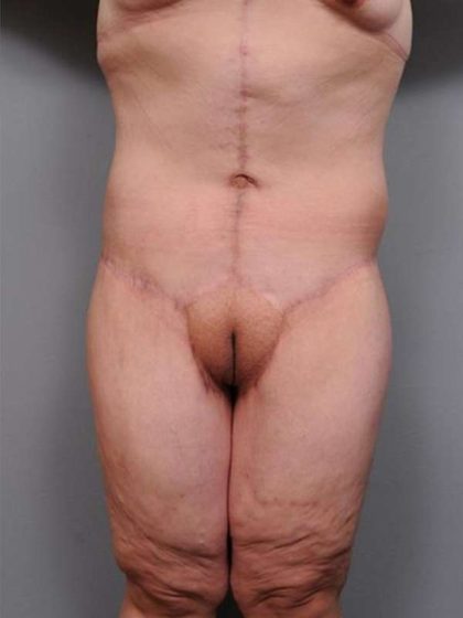 Lower Body Lift Before & After Patient #985