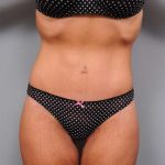 Lower Body Lift Before & After Patient #1010