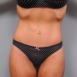 Lower Body Lift Before & After Patient #1010